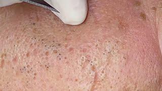 Old Age Blackheads Removal | Làm Sạch Mụn Đầu Đen Cho Khách Hàng Tuổi U60 -  SacDepSpa#236