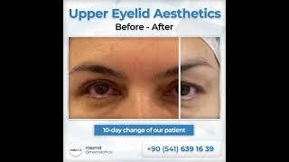 Upper Eyelied (Blepharoplasty) Surgery - Before & After | mezMD Health Tourism Agency