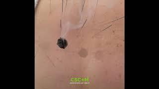 Acupuncture and Moxibustion for Low Back Pain | CSC+M NYC