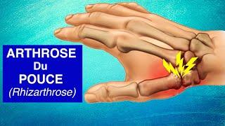 ARTHROSE DU POUCE (Rhizarthrose) : Explication, Diagnostic et Traitements