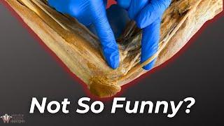 What Really Happens When You Hit Your "Funny Bone"