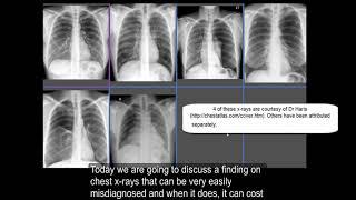 Chest Xray : Pneumothorax or no pneumothorax ( by hammadshams)