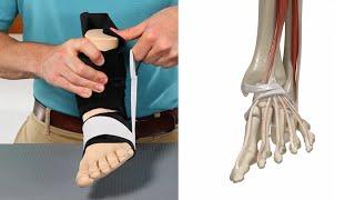 Lateral Ankle Sprains -  Treatment and Prevention