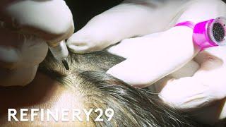 I Got a Non-Surgical Solution for Hair Loss | Macro Beauty | Refinery29