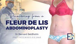 Recovering from a Fleur de lis abdominoplasty