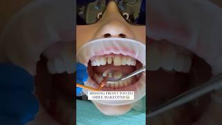 Missing Front Tooth Smile Makeover #veneers #cosmeticdentistry #smilemakeover