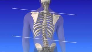 Scoliosis - Curvature of the Spine