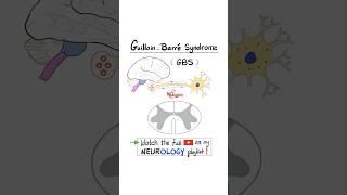 Guillain-Barré Syndrome (GBS) (Acute Inflammatory Demyelinating Polyradiculoneuropathy- AIDP)