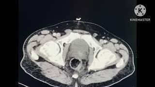 Intestinal Tuberculosis on CT.