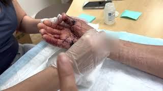 Wound Care For Post-Op Hand Surgery | Hand Therapy Secrets