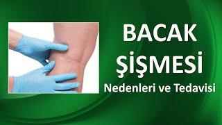 BACAK ŞİŞMESİ NEDENLERİ VE TEDAVİSİ