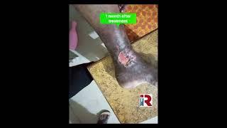 Varicose vein treatment #spiderveintreatment #varicoseveinstreatment #varicocele #youtubeshorts