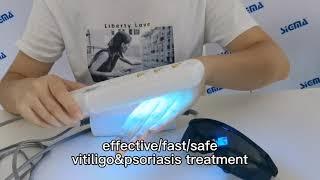 SIGMA SH1B-J product display: 311nm UVB phototherapy device vitiligo psoriasis treatment lamp