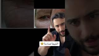 ودع تجاعيد تحت العين للأبد جلسة واحدة  | دكتور يوسف