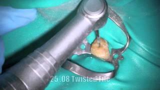 Molar Root Canal: Start to Finish