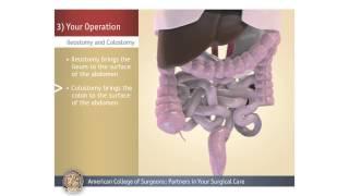 Colostomy/Ileostomy: Your Operation