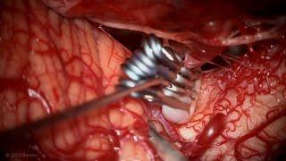 Clip Reconstruction of a PICA Aneurysm with Anterograde Fenestration Tube
