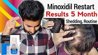 Minoxidil Restart 5 month Results Routine Shedding