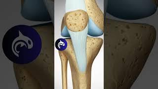 See how a Misaligned Knee Cap is fixed // Tibial Tubercle Osteotomy (TTO)