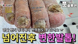 넘어진후 허리통증에 발관리 어려움! 문제성발 때문에 한의원도 못가셨다는 어머님 관리해드렸어요 #조원장의풋솔루션 #레푸스상도점 #레푸스동탄역점 #레푸스성남태평점 #레푸스 #문제성발톱