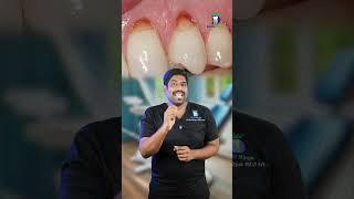 பல் சுத்தம் செய்தால் கூசுமா? Sensitivity during dental scaling | Dr.Karthikeyan | Denta Kings