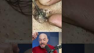 Monsterous ingrown hair #ingrownhair #doctorreacts