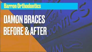 Damon Braces Before and After -Dr. Barron Patients