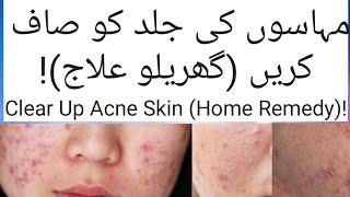 (مہاسوں کی جلد کو صاف کریں (گھریلو علاج)!) Clear Up Acne Skin (Home Remedy)! | #YoutTubeShorts |