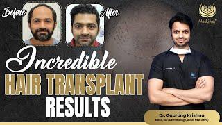 Incredible Hair Transplant Results | 9 Month Hair Transplant Results | Medlinks