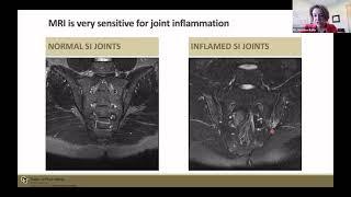 Spondyloarthritis Management and Research Highlights Presented by Rheumatologist Kristine Kuhn, MD