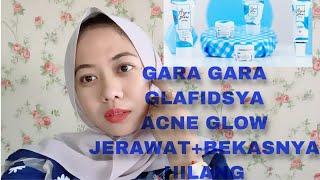 REVIEW PAKET ACNE GLOW GLAFIDSYA SKINCARE CREAM MALAM #glafidsyaskincare #glafidsya #acne #jerawat