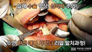 [FULL] 수면 완전 매복 사랑니 발치수술! 