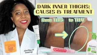 Dark Inner Thighs: Causes & Treatment | @BrownSkinDerm