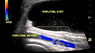 IFSMED ultrasound image - Baker's cyst