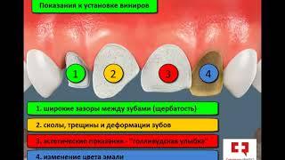 Виниры: установка, показания, вид зубов до и после