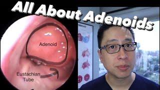 Adenoids and Adenoidectomy: what are they, when do we remove them, what is the surgery like