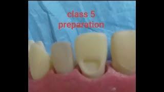 Class V  Cavity Preparation - TEETH SECTION - DR SAEED REDA