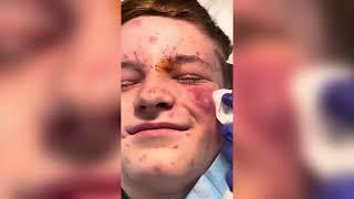 Popping huge blackheads and Giant Pimples - Best Pimple Popping Videos #184