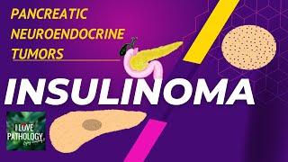 Pancreatic NeuroEndocrine Tumors ( PanNETs):  Insulinoma