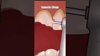 Cosmetic fillings for front  teeth #cosmetics #teeth #whitening #teeth #laser #tech #beauty #makeup