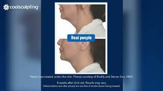 Real CoolSculpting Results - Remove Unwanted Fat with CoolSculpting and NO Surgery!