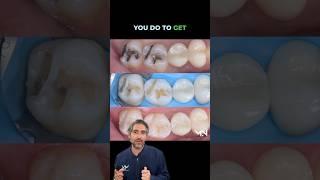 Why are simple direct restorations the most important in Biomimetic dentistry?  #dentist #dental