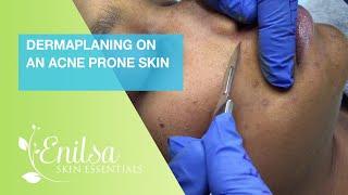 Dermaplaning On An Acne Prone Skin