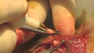 Vasectomy