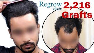 Best Hair Transplant Result 2021 || NW Grade II || 2,216 Grafts ||  @Regrow Clinic ​