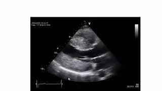 Tracing of Valvular Heart Disease (Echo & CMR), Dr. Youssef Amin