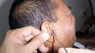 Removing Something Stuck for Days in Man's Ear | What is It?