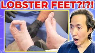 His Hands and Feet Resemble LOBSTER CLAWS?!?! Doctor Reacts to My Feet Are Killing Me!