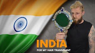 After Liam's third Hair Transplant in India, watch his Hair Transplant Result