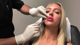 Love Your Lips - Lip Enhancement in Action